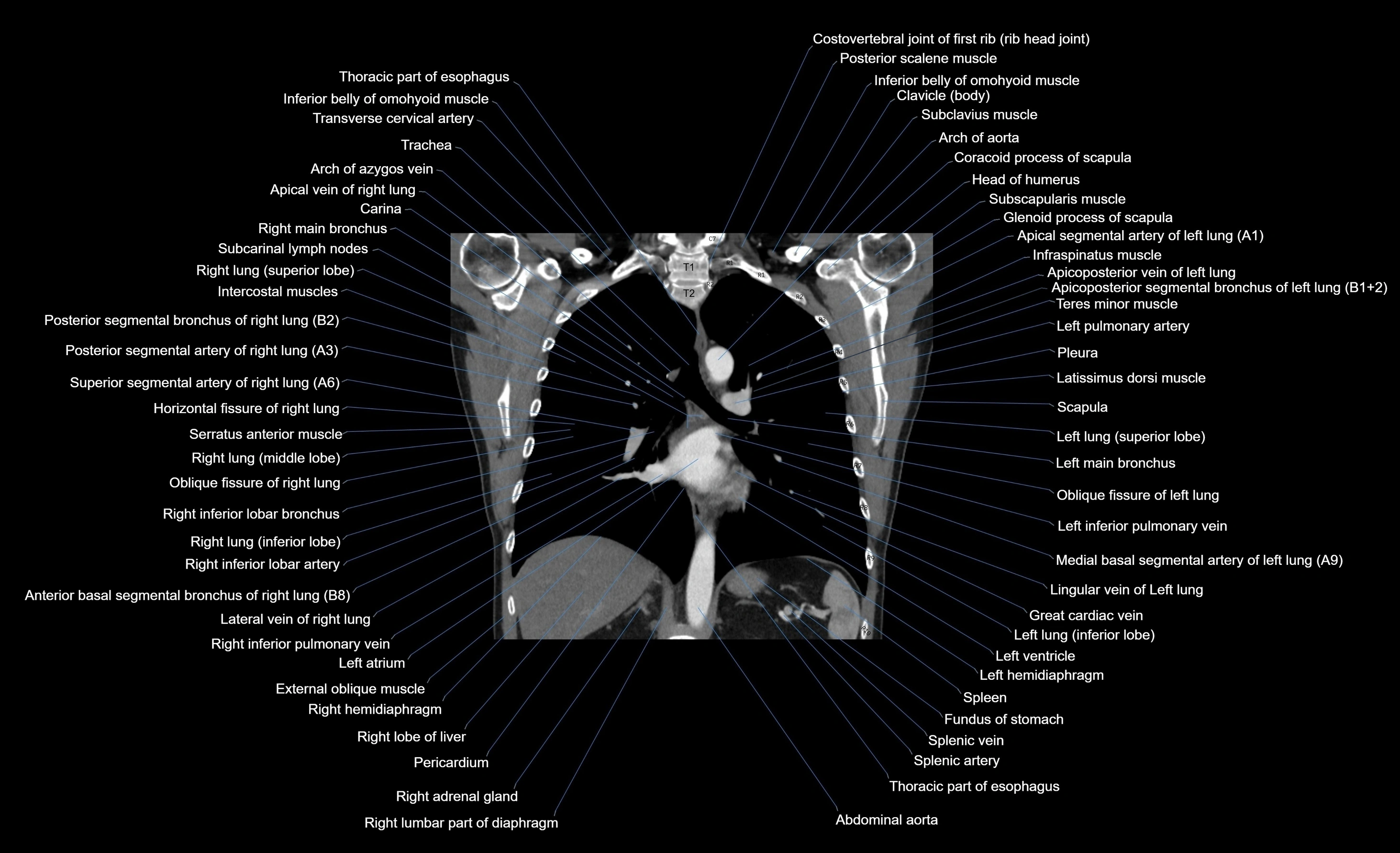 CT chest (thorax) soft tissue window labelled coronal cross sectional anatomy radiology image-00053.webp